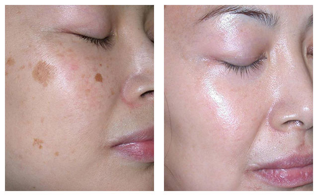 skin-pigmentatrion-before-after